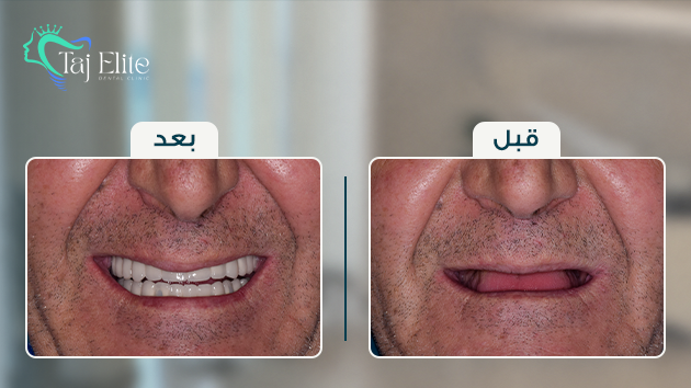 before-^-after3